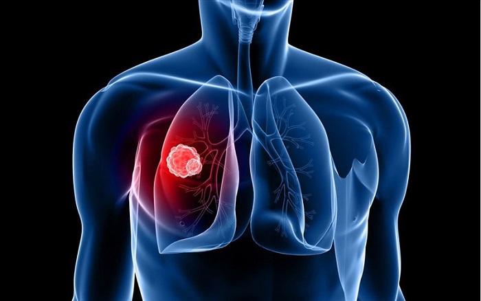 dấu hiệu ung thư phổi